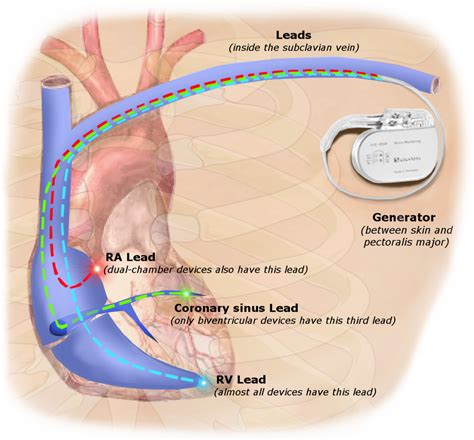 Pacemaker terminology - Questions and Answers in MRI