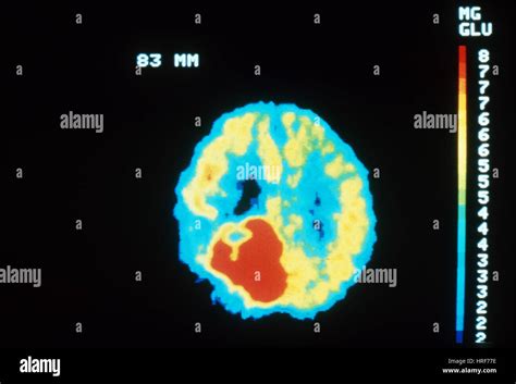 PET Brain Scan, Malignant Tumor Stock Photo - Alamy