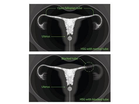 Hysterosalpingogram(HSG) Test Cost, Risks, Success Rate, Procedure ...