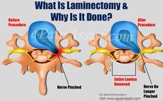 Lumbar laminectomy | back therapy | Spine surgery, Surgery recovery ...