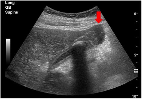 Diagnosing Gallbladder Perforation With Contrast-Enhanced Ultrasound: A ...