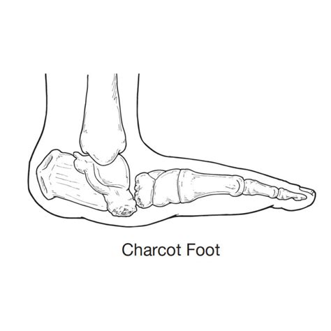 Charcot Foot - Sun Valley Foot & Ankle