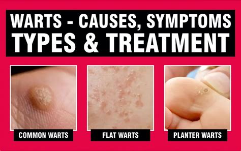 Wart 101: Causes, Types, Symptoms, Prevention, Removal And Treatments