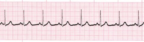 Normal Sinus Rhythm training - ACLS Cardiac Rhythms video | ProACLS