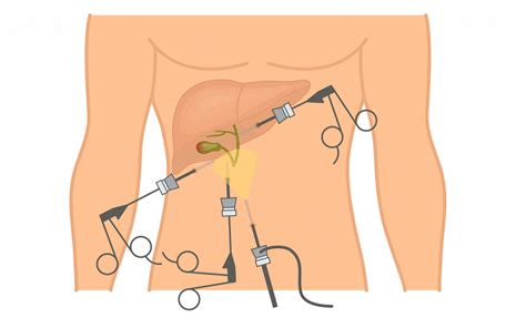 Laparoscopic cholecystectomy: Benefits, Contraindications, Procedure ...