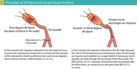 Overview of atrioventricular (AV) blocks – ECG learning