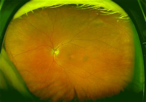 Subcapsular cataract