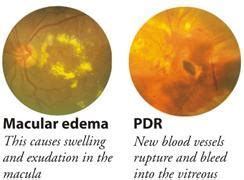 Retinal Diseases — Vikaspedia