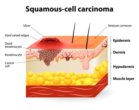 Squamous Cell Carcinoma (SCC) - CBD Skin Cancer Clinic