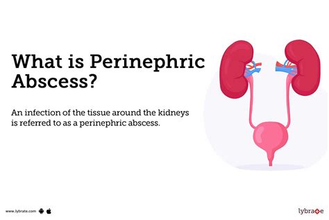 Perinephric Abscess: Causes, Symptoms, Treatment and Cost