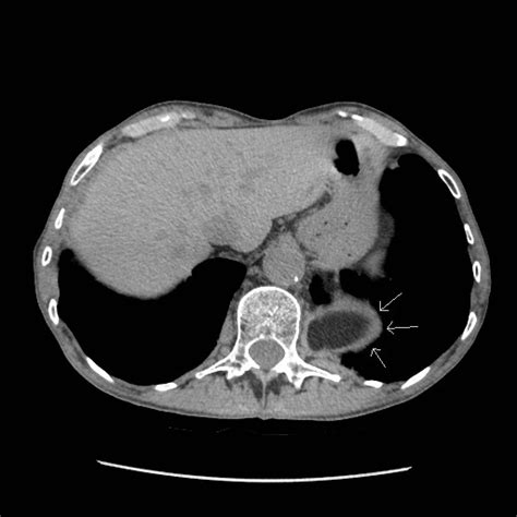 Bochdalek Hernia – RADIOLOGYPICS.COM