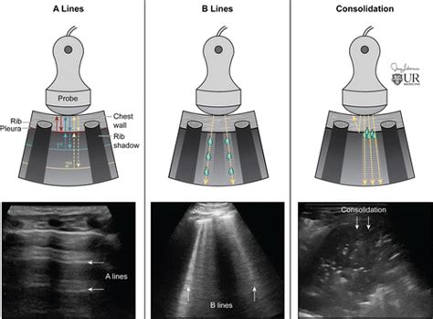 Lung Ultrasound: The Essentials | Radiology: Cardiothoracic Imaging