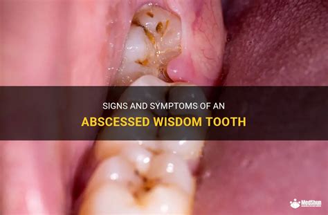 Signs And Symptoms Of An Abscessed Wisdom Tooth | MedShun