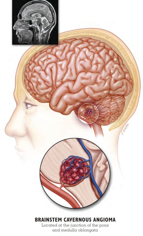 Brainstem Lesions - Alliance to Cure Cavernous Malformation