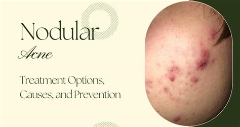 Nodular Acne and Treatment Options: Causes, Prevention