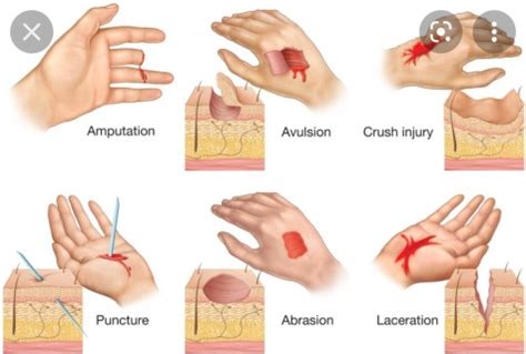 Wound - Emedicodiary