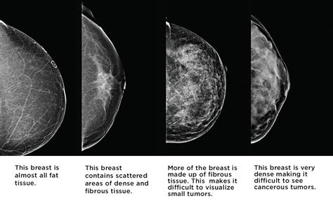 Mammogram or ultrasound or both? - Dr. Zembroski