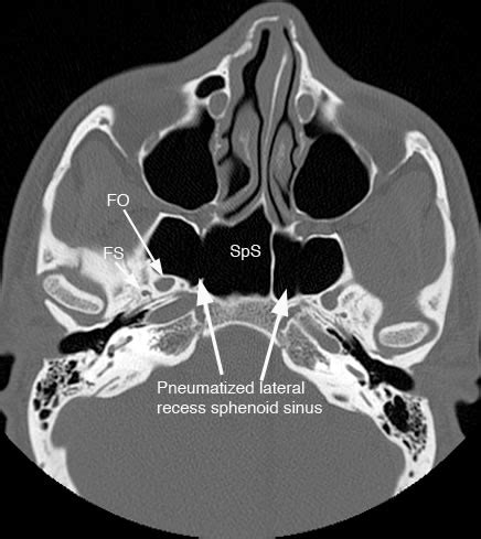 Sphenoid Sinusitis; Sinusitis, Sphenoid