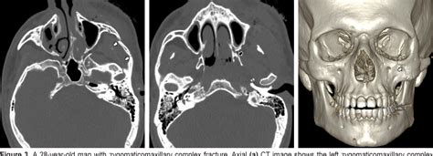 Pterygoid Plate Fracture