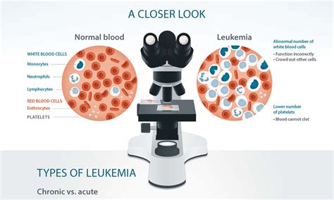 Types of Leukemia: Common, Rare & More