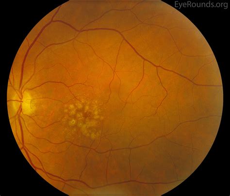 Age-related macular degeneration