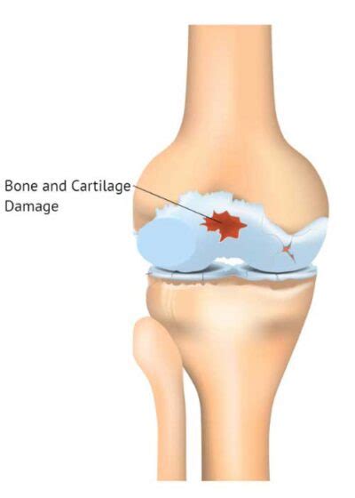 Osteochondral Defect | Knee Articular Cartilage Damage |Orthopedic Knee ...