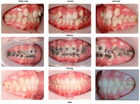 Braces Before and After Photo Gallery - orthodontics