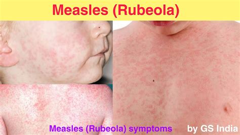 Measles (rubeola)-Sign & Symptoms, Measles Stages, measles vaccine ...