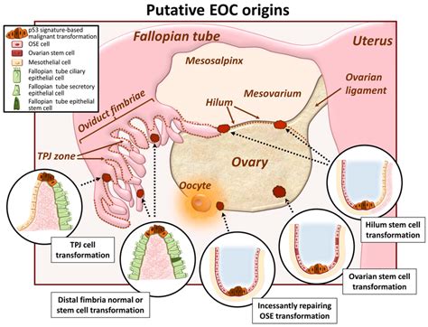 Ovarian Cancer Diagram