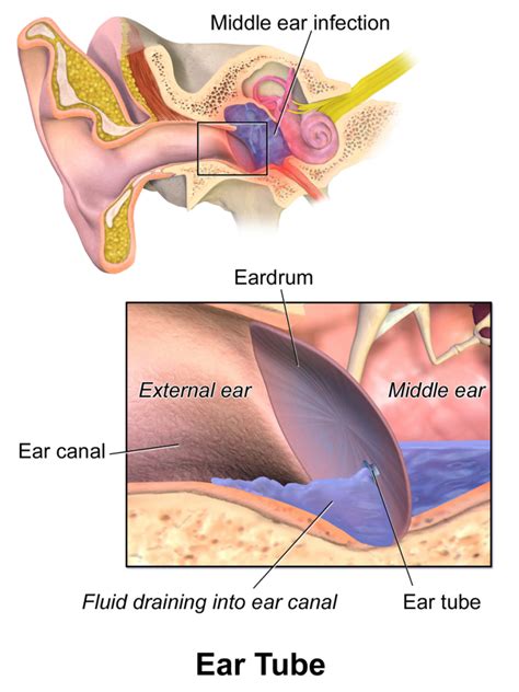 Managing Middle Ear Fluid | Clear Choice Hearing and Balance