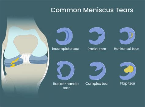 Meniscus Tear Specialists in NJ & NYC | The Spine & Rehab Group