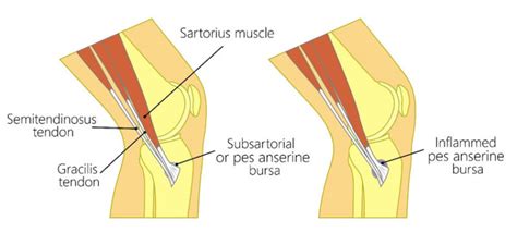 Pes Anserine Tendinopathy/Bursitis - Ultrasound Guided Injections