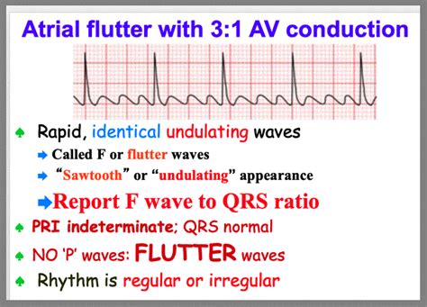 Atrial Flutter Vs Atrial Fibrillation