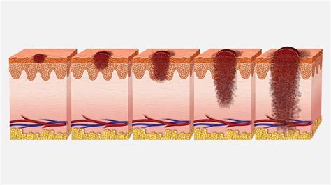 Stages of Melanoma Skin Cancer | Christ Memorial