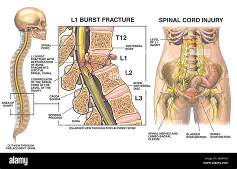 L1 Compression Burst Fracture with Spinal Cord Injury Stock Photo ...