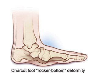 Charcot Foot | Cleveland Clinic | Feet treatment, Cleveland clinic ...