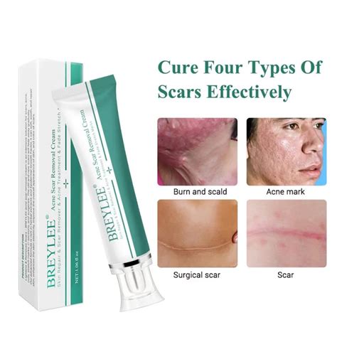 Acne Scar Removal Cream 30g Face Cream Skin Repair Skin Care Scar Acne ...