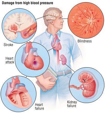 Guide de l'hypertension artérielle (Hypertension) : Causes, symptômes ...