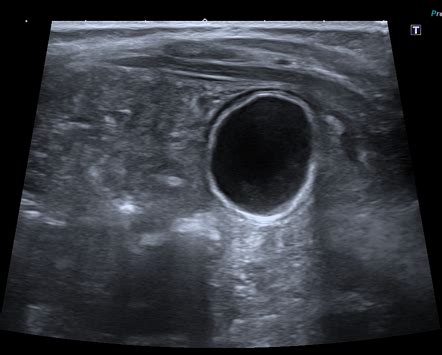 Enteric duplication cyst | Radiology Case | Radiopaedia.org