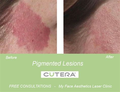 Skin pigmentation Treatments | Hyperpigmentation | Bolton Laser Clinic