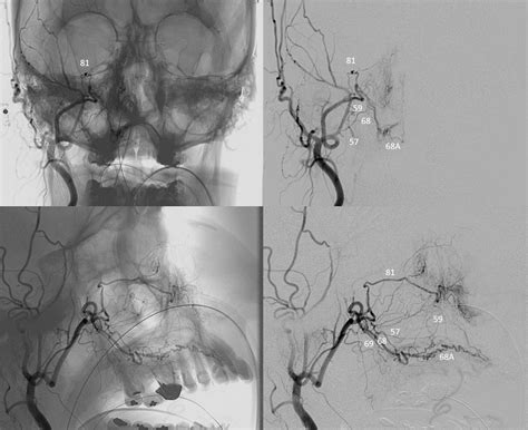 Infraorbital Artery | neuroangio.org