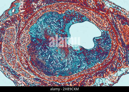 ATHEROMA, HISTOLOGY Stock Photo - Alamy