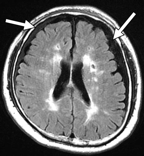 Traumatic Brain Injury Mri