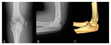 Pediatric Medial Epicondyle Fracture A New Procedure For Fractures Of ...