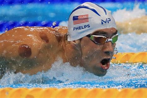 Cupping at the Rio Olympics? - G&L Acupuncture and Wellness Center