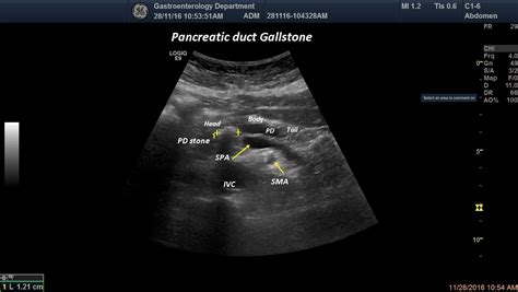 Chronic Pancreatitis Ultrasound