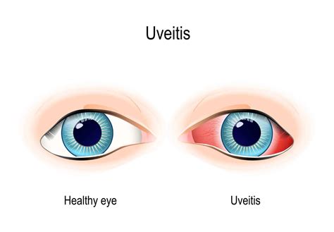 What is Uveitis? - Henderson Eye Care