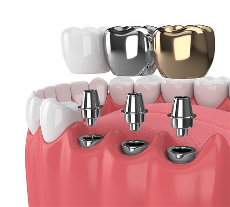 What are the best types of dental implants? - Healthy Smile Dental