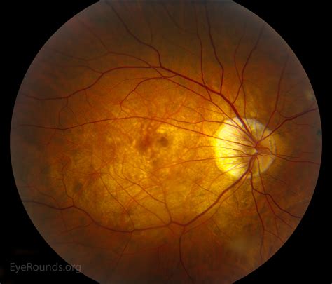 Atlas Entry - Pathologic myopia with bilateral posterior staphylomas