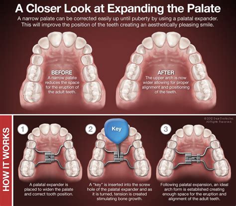 Palatal Expanders | Orthodontic Associates | Bloomington IL